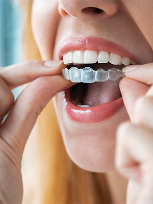 invisalign treatment